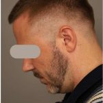 Neck Lift For Men Before & After Patient #2463