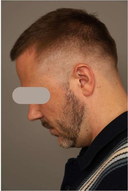 Neck Lift For Men Before & After Patient #2463