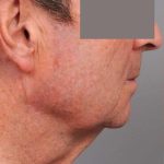 Neck Lift For Men Before & After Patient #2471