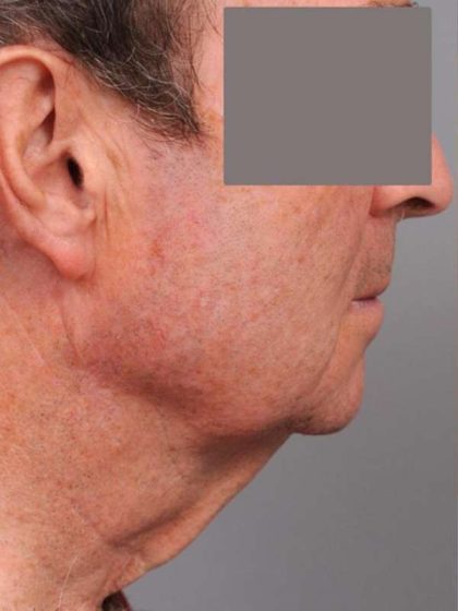 Neck Lift For Men Before & After Patient #2471