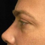 Eyelid Surgery For Men Before & After Patient #2481