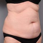 Tummy Tuck Before & After Patient #450