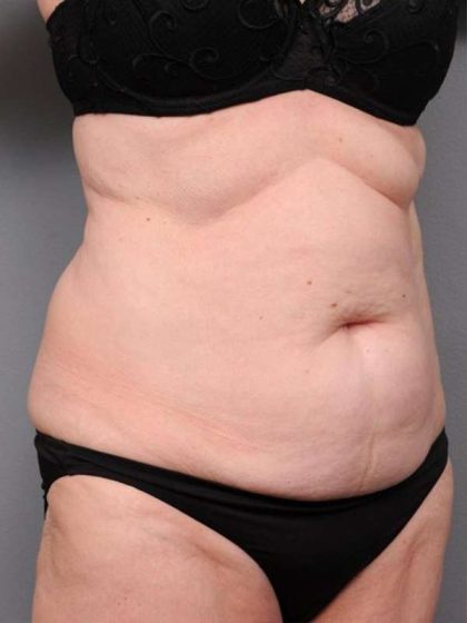 Tummy Tuck Before & After Patient #450