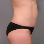 Mommy Makeover Before & After Patient #2506