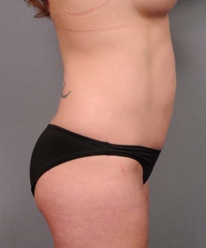 Mommy Makeover Before & After Patient #2506