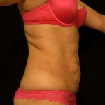 Mommy Makeover Before & After Patient #2513