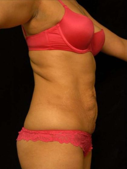 Mommy Makeover Before & After Patient #2513