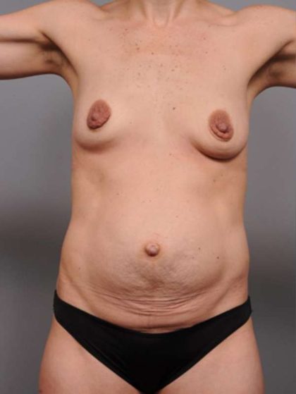 Mommy Makeover Before & After Patient #2520