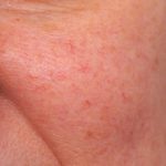 IPL Photofacial Before & After Patient #2548