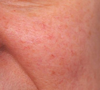 IPL Photofacial Before & After Patient #2548