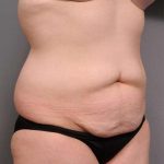 Tummy Tuck Before & After Patient #463