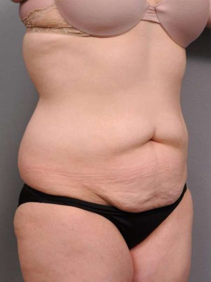 Tummy Tuck Before & After Patient #463