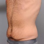 Tummy Tuck Before & After Patient #482