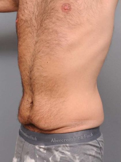 Tummy Tuck Before & After Patient #482