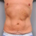 Tummy Tuck Before & After Patient #489