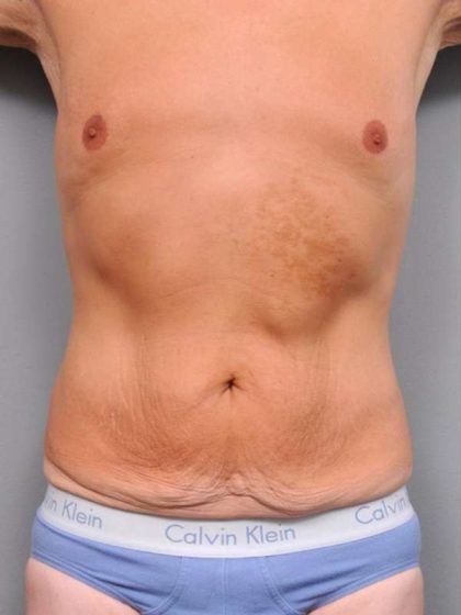 Tummy Tuck Before & After Patient #489