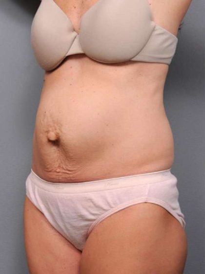 Tummy Tuck Before & After Patient #497