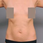Tummy Tuck Before & After Patient #504
