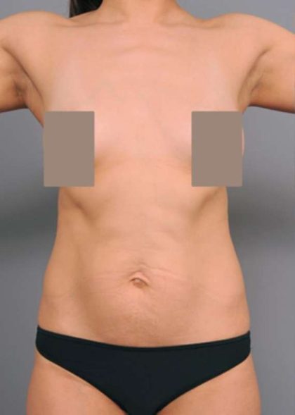 Tummy Tuck Before & After Patient #504