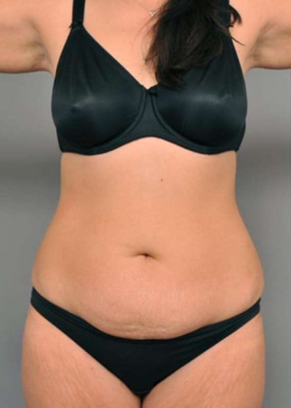 Tummy Tuck Before & After Patient #515