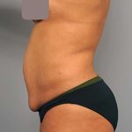 Tummy Tuck Before & After Patient #522