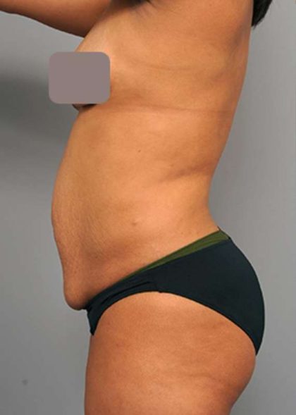 Tummy Tuck Before & After Patient #522