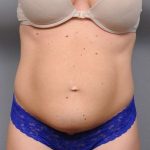 Tummy Tuck Before & After Patient #537