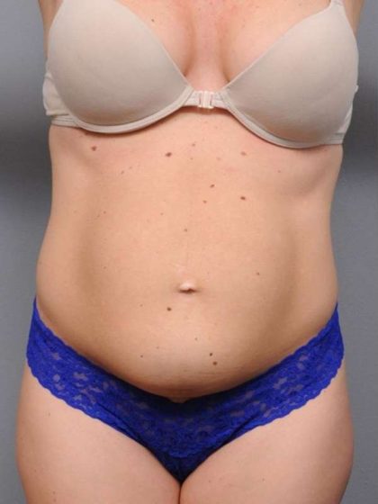 Tummy Tuck Before & After Patient #537