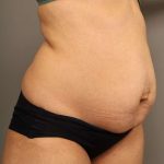 Liposuction Before & After Patient #550