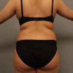 Liposuction Before & After Patient #563