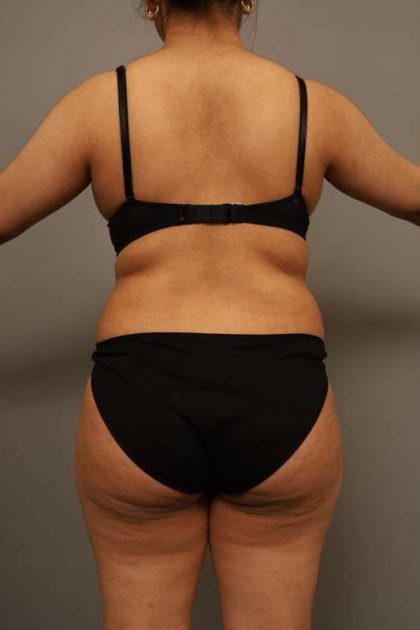 Liposuction Before & After Patient #563