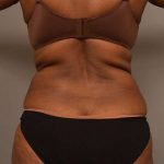 Tummy Tuck Before & After Patient #574