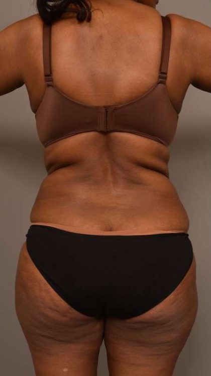 Tummy Tuck Before & After Patient #574