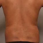 Liposuction Before & After Patient #581