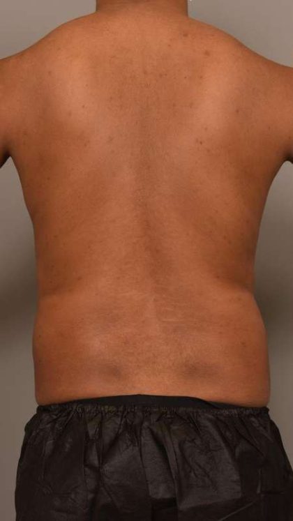 Liposuction Before & After Patient #581
