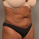 Liposuction Before & After Patient #604