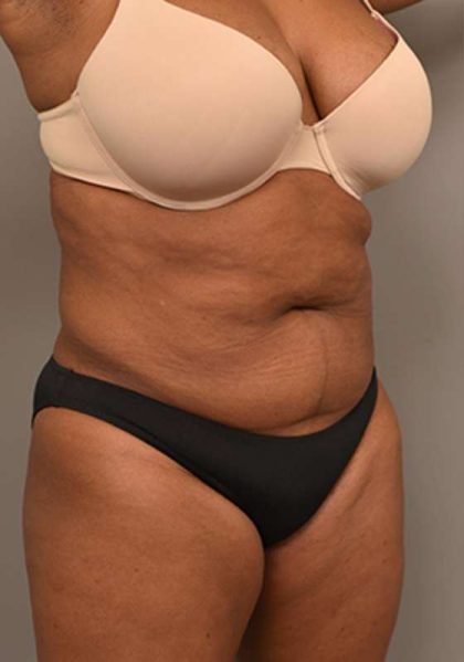 Liposuction Before & After Patient #604