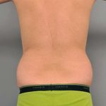 Liposuction Before & After Patient #611
