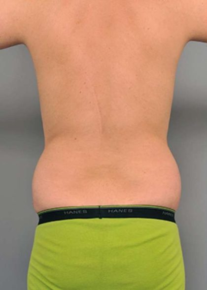 Liposuction Before & After Patient #611