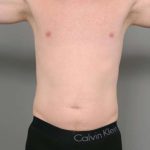 Liposuction Before & After Patient #618