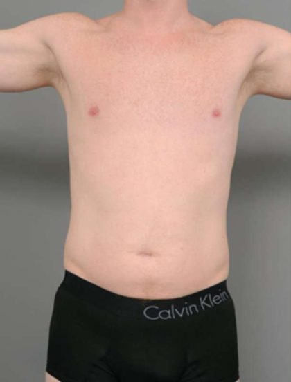 Liposuction Before & After Patient #618