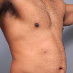 Liposuction Before & After Patient #626