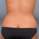 Liposuction Before & After Patient #635