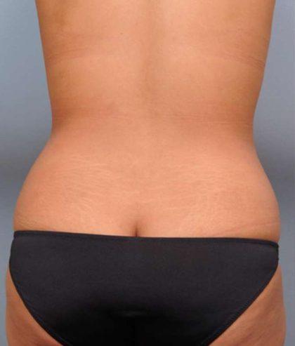 Liposuction Before & After Patient #635