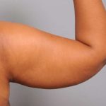 Liposuction Before & After Patient #655