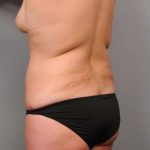 Liposuction Before & After Patient #662