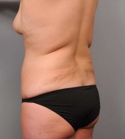 Liposuction Before & After Patient #662