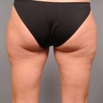 Liposuction Before & After Patient #674