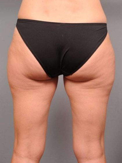 Liposuction Before & After Patient #674