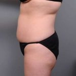 Liposuction Before & After Patient #681